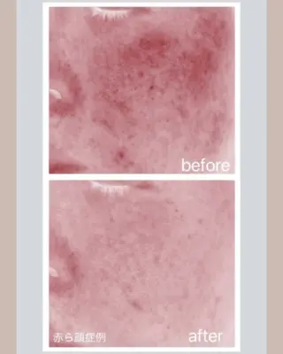 .
赤ら顔にお悩みの方へ👩‍⚕️✨
.
当院では、お顔の赤みの症状やお肌の状態に合わせて、
2種類の治療機器から最適な方法をご提案いたします。

🔹Vビームレーザー：血管病変に特化し、赤みの原因にピンポイントでアプローチ。
🔹ノーリス（IPL光治療）：赤みだけでなく、シミやくすみなど複合的なお悩みにも対応。

赤ら顔のタイプやライフスタイルに合わせて、オーダーメイドで治療プランを組み立てます💡
まずはお気軽にご相談くださいませ🌿
.
.
.
#赤ら顔治療 #Vビームレーザー #ノーリス #IPL光治療 #顔の赤み #毛細血管拡張症 #酒さ #皮膚科 #美容皮膚科 #福知山皮膚科 #肌質改善 #透明感のある肌 #赤み対策 #美肌ケア #皮膚科専門医 #福知山美容皮膚科 #赤ら顔改善 #光治療 #血管腫レーザー #美容医療