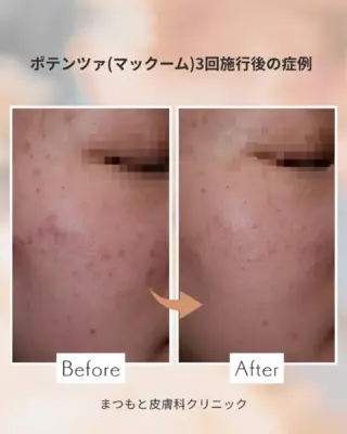 .
「“もう治らないかも…”と思っていたニキビ跡も、適切な治療で改善が可能です。

肌質やニキビ跡のタイプに合わせて、レーザーや薬剤治療、ニードルRFなどをオーダーメイドで組み合わせます。

きれいなお肌への一歩を、私たちと一緒に踏み出しませんか？✨」

#ニキビ跡治療 #ニキビ改善 #美肌治療 #皮膚科医監修
#美容皮膚科 #ニキビ跡改善 #ポテンツァ#Vビーム#レーザー治療 #赤み改善#治りにくいニキビ跡
#美肌再生 #肌質改善 #京都皮膚科 #美容医療#福知山美容