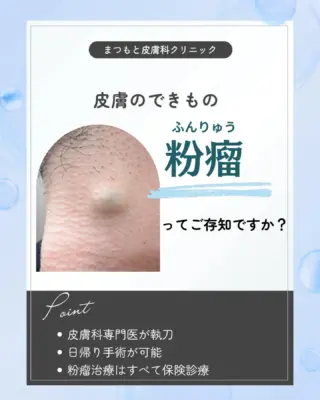 .

皮膚のできもの「粉瘤　ふんりゅう」
ってご存知ですか

皮膚にできるしこりの中でも、よく見られるのが 粉瘤（ふんりゅう） です。
「脂肪のかたまり」や「できもの」と思われがちですが、実際には皮膚の袋の中に角質や皮脂がたまって膨らんでしまう良性の腫瘍です。

✔ 放置すると炎症を起こして赤く腫れることも
✔ 自然に治ることはなく、根本的な治療には手術で袋ごと取り除く必要があります
✔ 良性の腫瘍ですが、繰り返す炎症や見た目の悩みで受診される方も多いです

👩‍⚕️ 当院では、診察の際に
✅ 視診
✅ 触診
に加えて、超音波エコー検査を取り入れています。

皮膚の下の状態までしっかり確認することで、
より正確で安心できる診断につなげています✨

皮膚腫瘍（できもの）に不安がある方は、お気軽にご相談くださいませ

#粉瘤 #皮膚腫瘍 #しこり #皮膚科 #皮膚科医が解説 #良性腫瘍 #皮膚のトラブル #日帰り手術 #まつもと皮膚科クリニック #福知山皮膚科#皮膚のできもの